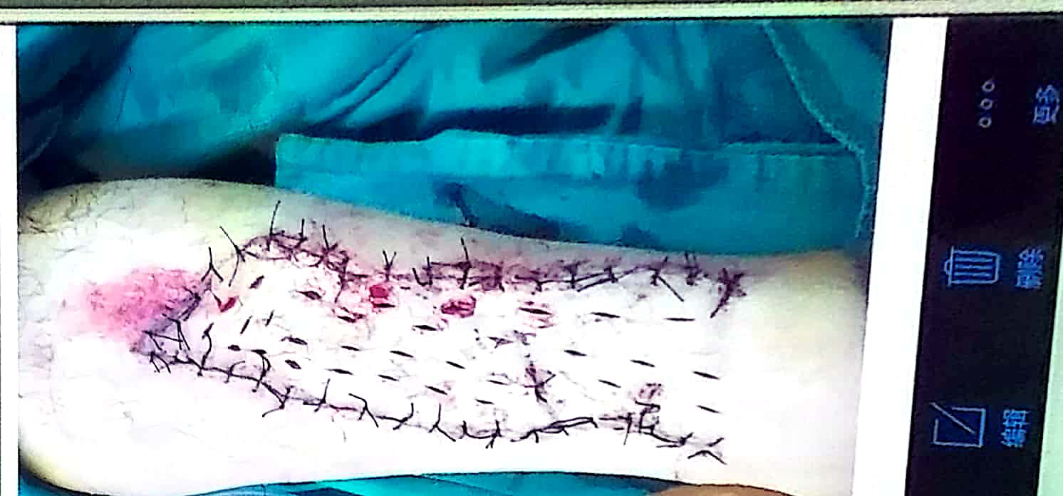 刘碧雄受伤 刘碧雄受伤